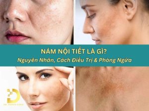 Nám nội tiết là gì?