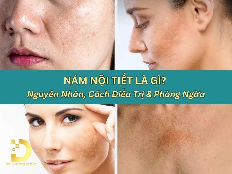 Nám nội tiết là gì? 