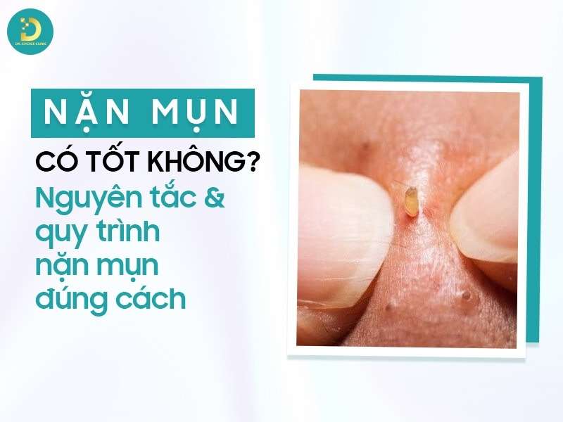Nặn mụn có tốt không?