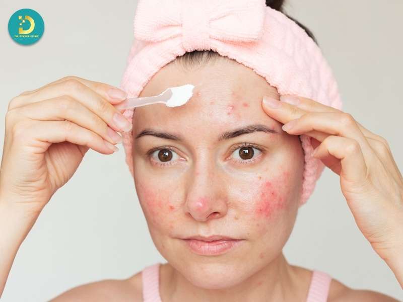 Nên chấm mụn hay bôi toàn mặt?