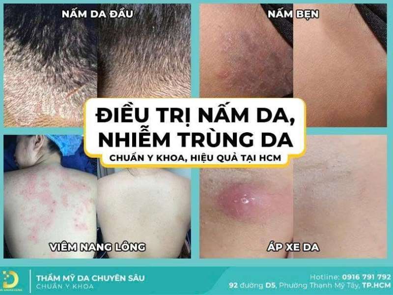 Nên điều trị nấm da ở đâu an toàn, hiệu quả HCM?