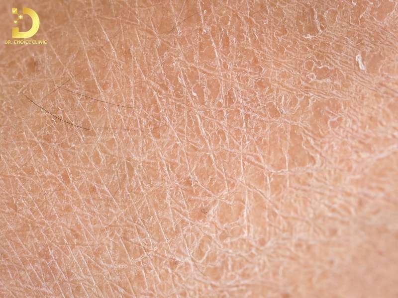 Nguyên nhân gây da khô là gì?