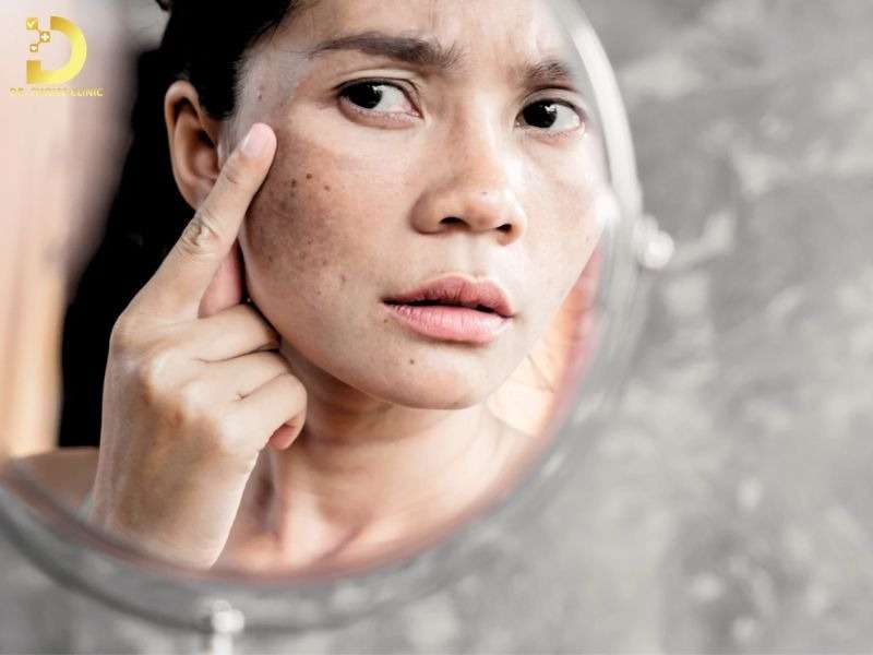 Nguyên nhân hình thành nám da là gì?