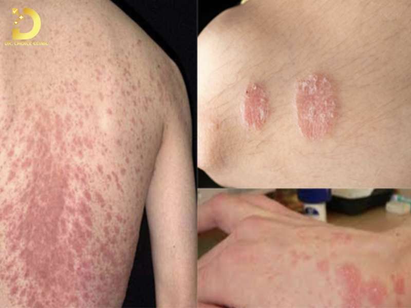 Nguyên nhân hình thành nấm da là gì?