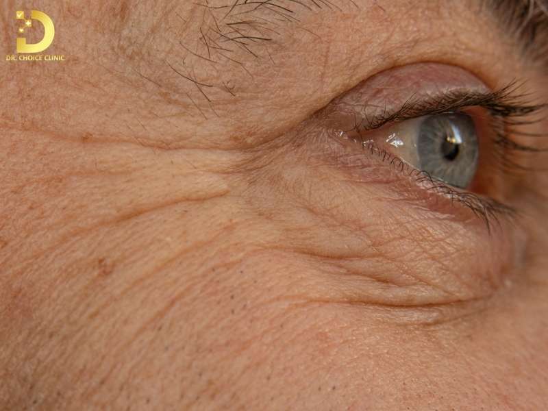 Nguyên nhân khiến vùng da mắt nhanh xuất hiện nếp nhăn