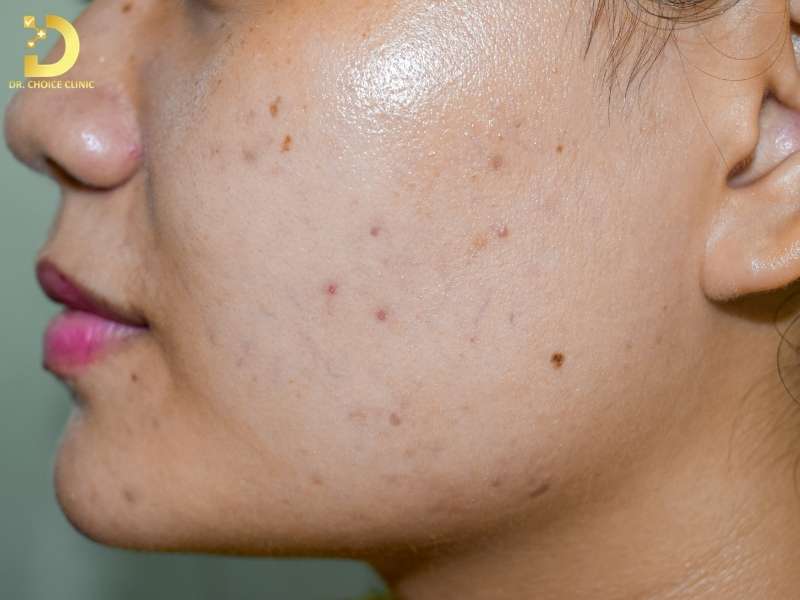 Nguyên nhân nào dẫn đến tình trạng da dầu?