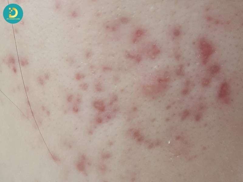 Nguyên nhân phổ biến gây thâm đỏ sau viêm thường bắt đầu từ những tổn thương quen thuộc này