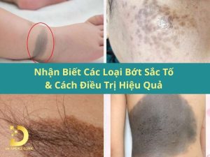 Nhận biết các loại bớt sắc tố & cách điều trị