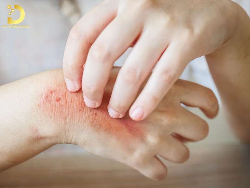 Những sai lầm thường gặp khi điều trị nấm da tại nhà