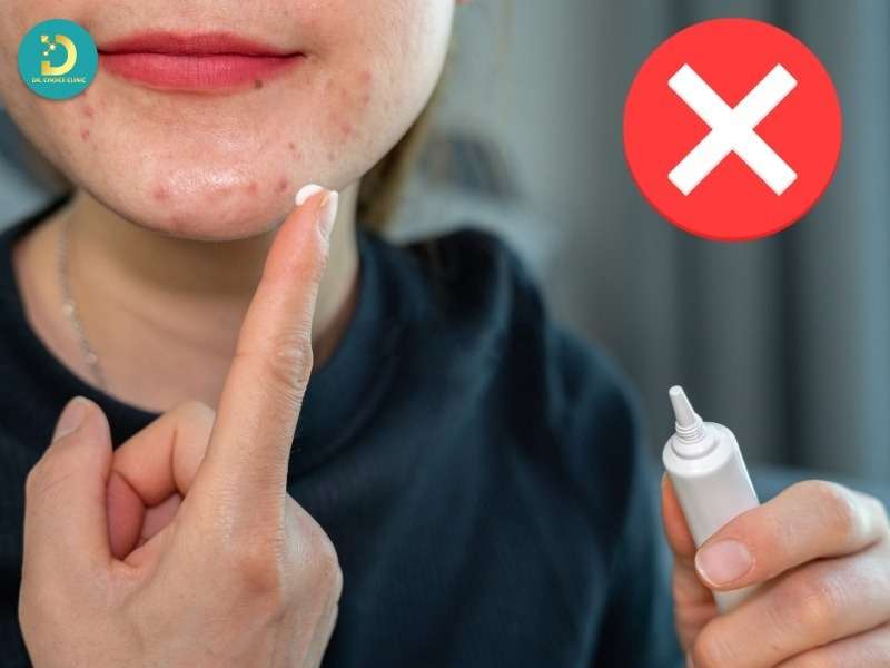 Những sai lầm thường gặp khi dùng kem trị mụn