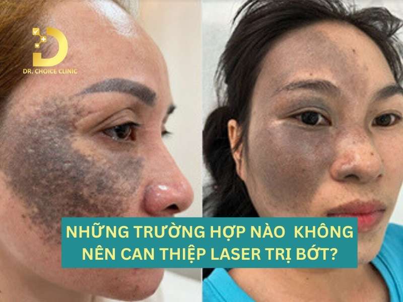 Những trường hợp nào bác sĩ khuyến cáo tạm hoãn hoặc không nên can thiệp Laser?