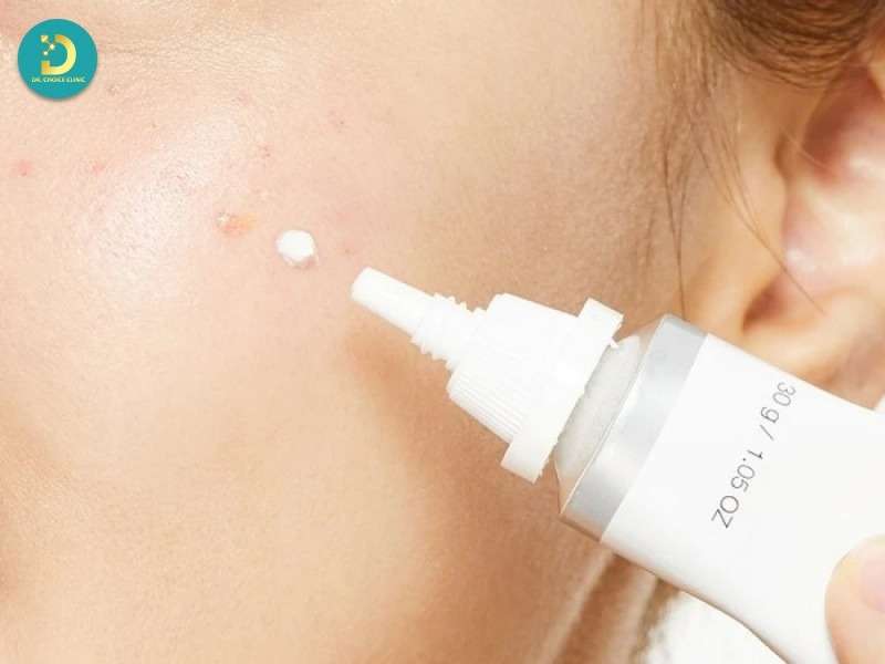 Phân biệt kem trị mụn với các sản phẩm trị mụn khác