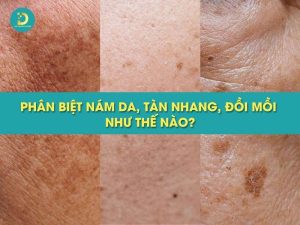 Phân biệt nám da, tàn nhang, đồi mồi