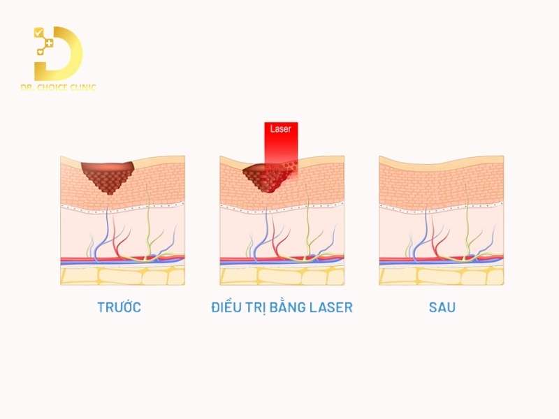 Phương pháp điều trị bớt sắc tố nào mang lại hiệu quả cao?