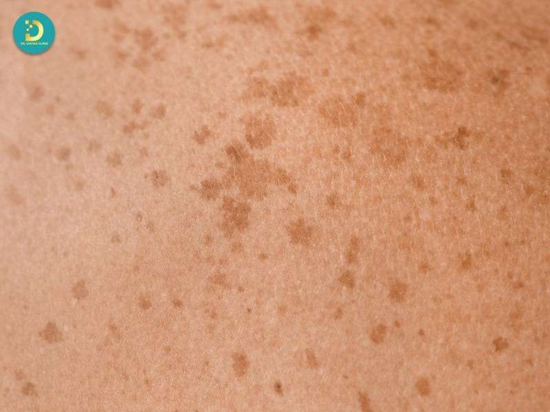 Rối loạn sắc tố da là gì? 