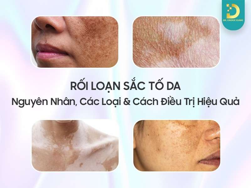 Rối loạn sắc tố da