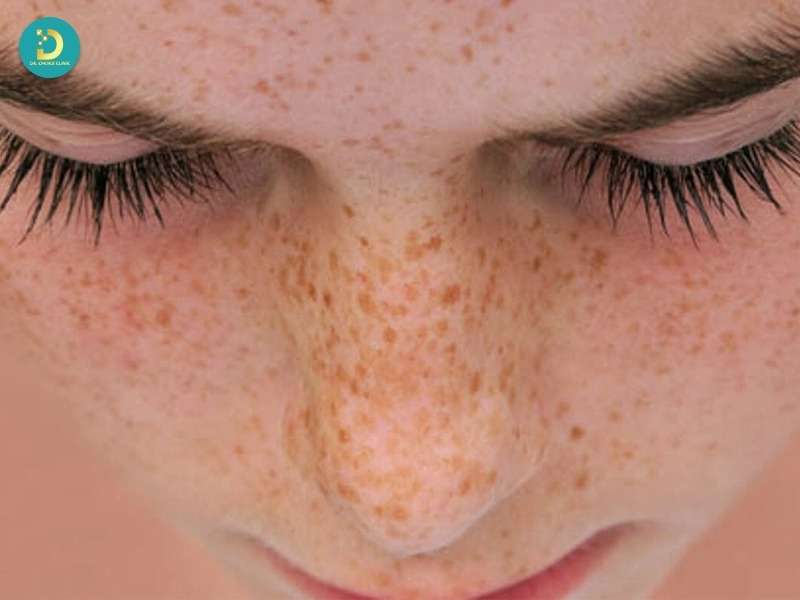 Rối loạn tăng sắc tố da