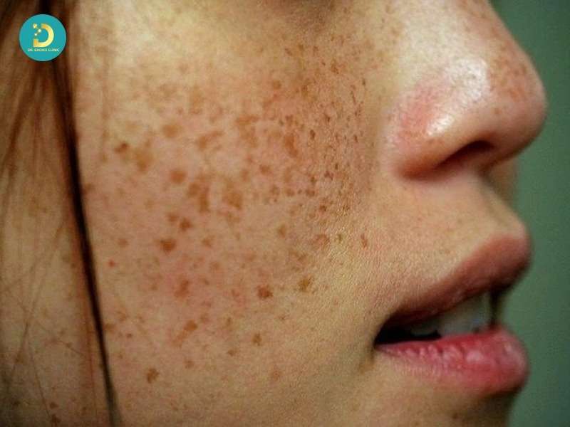 Tàn nhang (Freckles)