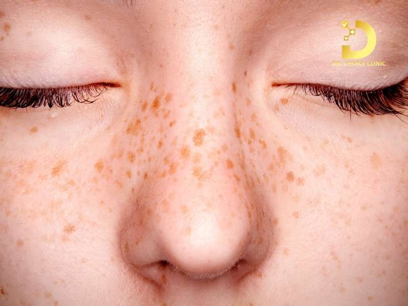 Tàn nhang là gì? làm thế nào nhận biết chính xác tình trạng trên?