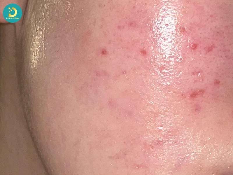 Thâm đỏ (hồng ban sau viêm) là gì? hiểu đúng bản chất trước khi điều trị