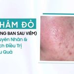 Thâm đỏ (hồng ban sau viêm)