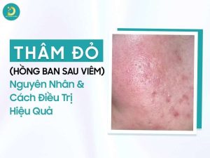 Thâm đỏ (hồng ban sau viêm)