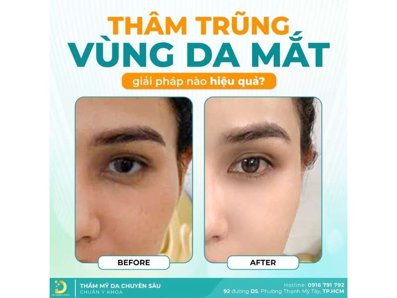 Địa chỉ nào xóa nhăn vùng da quanh mắt an toàn, hiệu quả tại HCM?