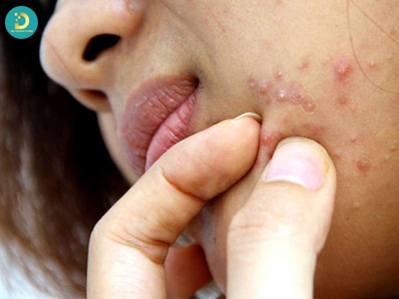 Trường hợp nặn mụn gây hại nhiều hơn lợi