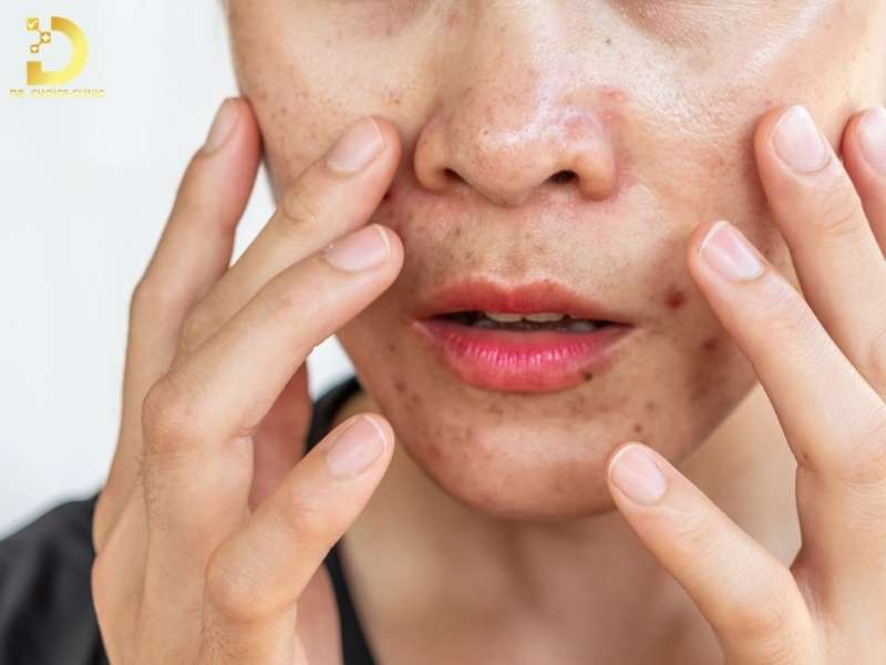 Các vấn đề thường gặp ở da hỗn hợp