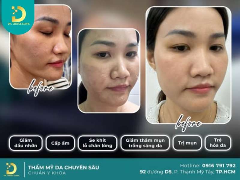 Đơn vị nào điều trị thâm da hiệu quả, uy tín tại TP. Hồ Chí Minh?