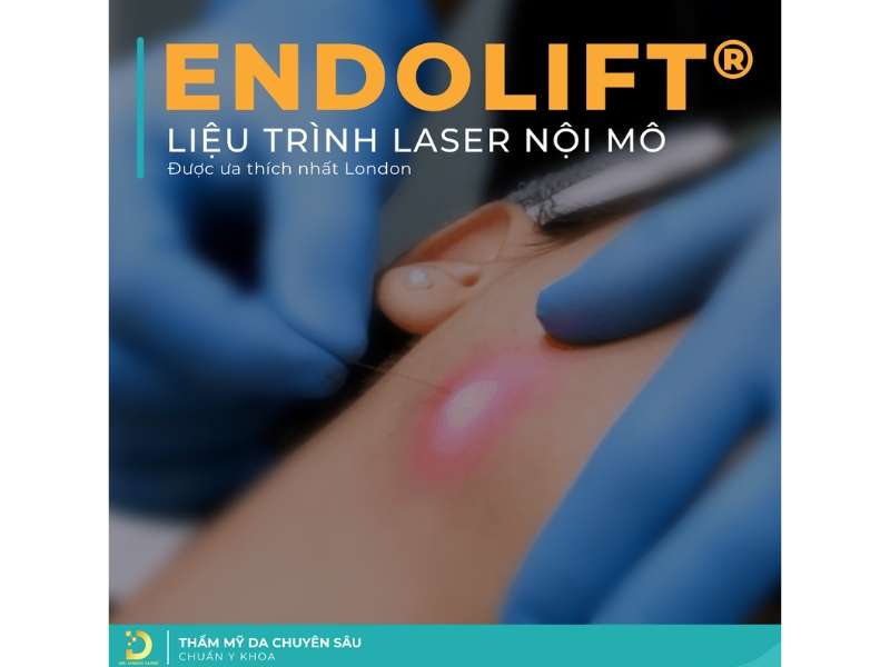 Laser nội mô Endolift