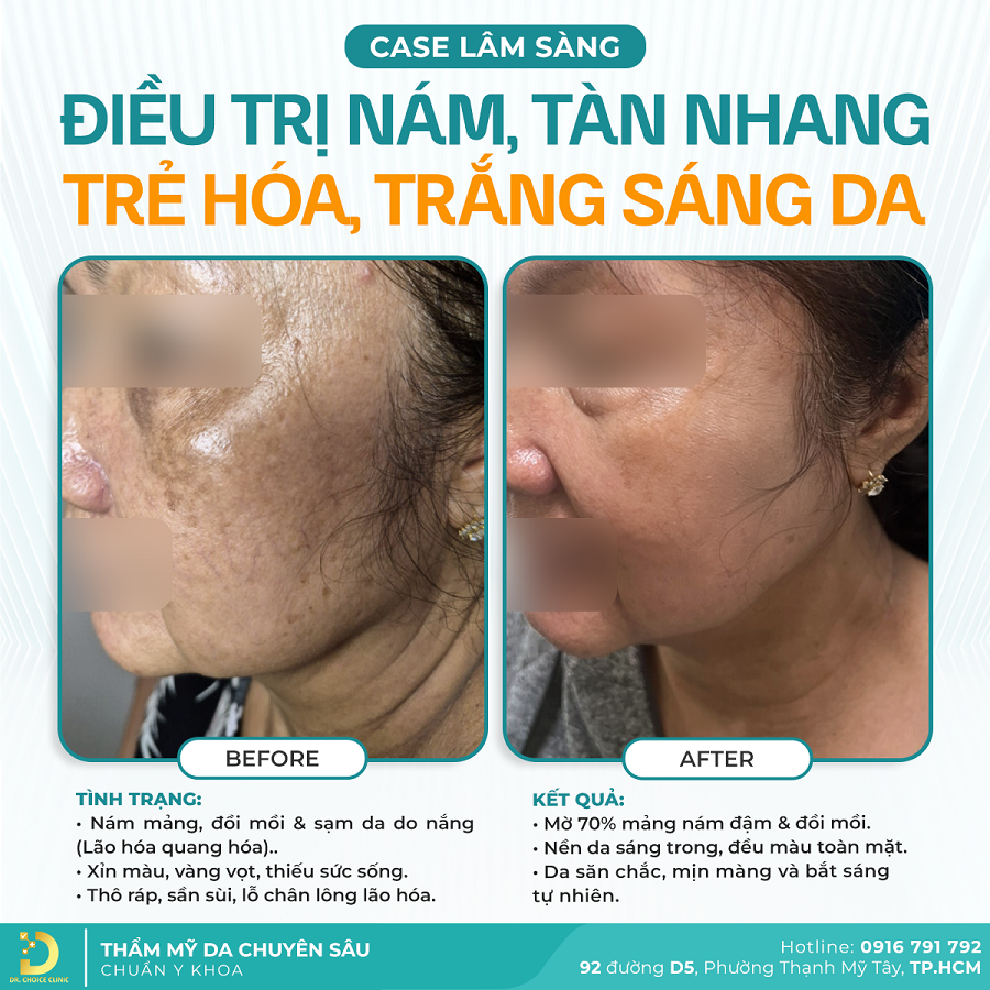 3 tre hoa da DRC634 FB