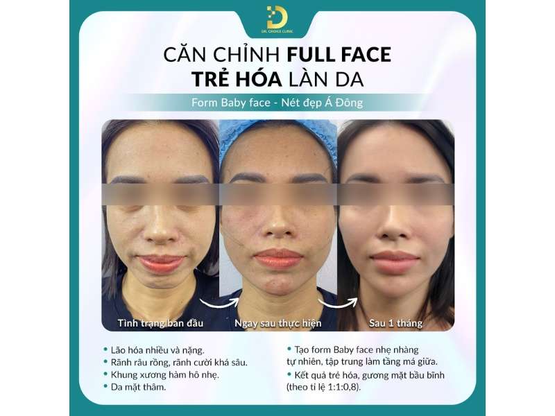 cân chỉnh full face trẻ hóa làn da