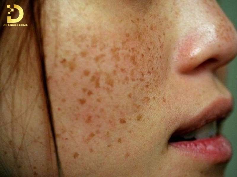 Dấu hiệu nhận biết tàn nhang bẩm sinh trên da