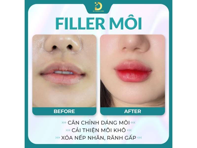 Filler môi cân chỉnh dáng môi, cải thiện môi khô, xóa nếp nhăn, rãnh gấp
