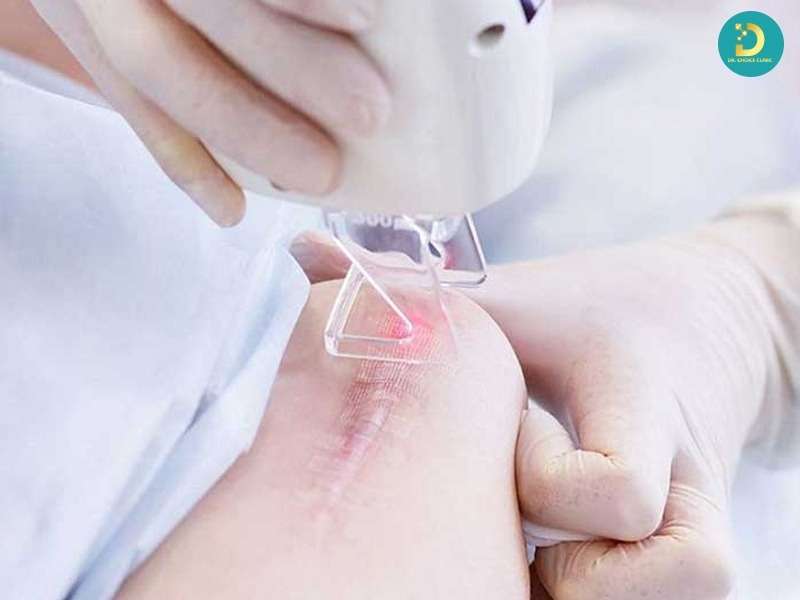 Liệu trình điều trị sẹo lồi đỏ 4IN1 (Nội khoa chuyên sâu)