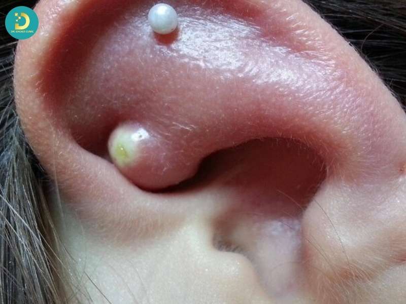 Nguyên nhân gây sẹo lồi vành tai là gì?