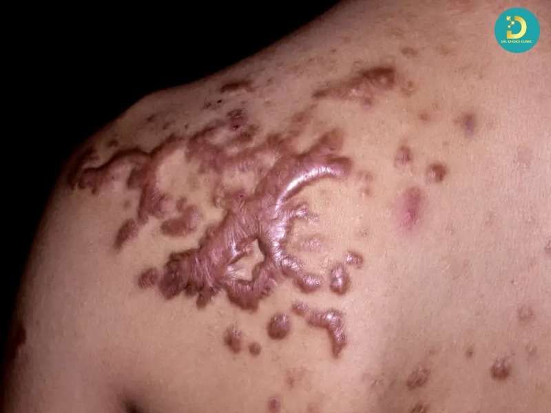 Nguyên nhân hình thành