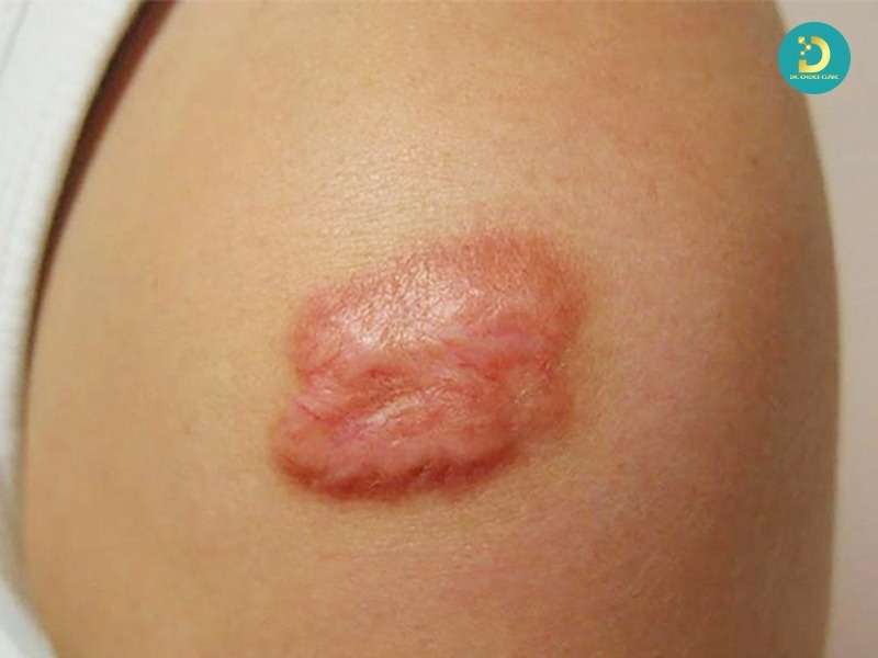 Sẹo lồi đỏ và ngứa là gì? có nguy hiểm không?