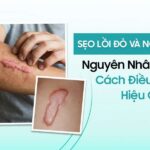 Sẹo lồi đỏ và ngứa