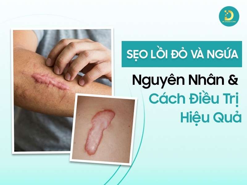 Sẹo lồi đỏ và ngứa