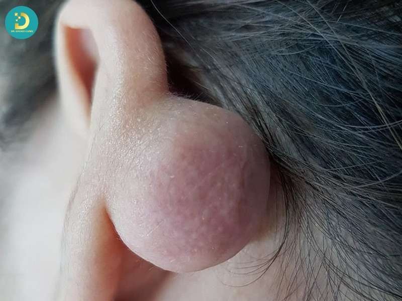Sẹo lồi vành tai là gì? hiểu đúng để điều trị hiệu quả