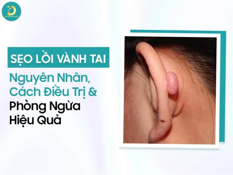 Sẹo lồi vành tai