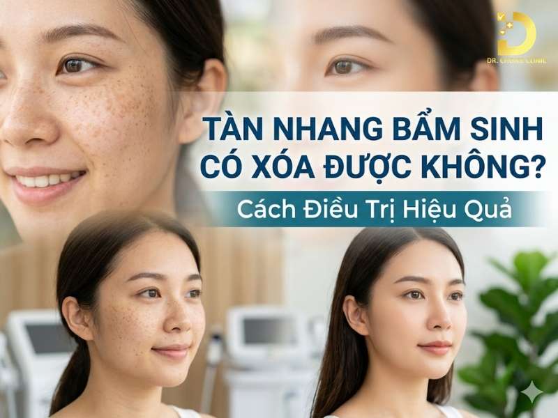 Tàn nhang bẩm sinh là gì?