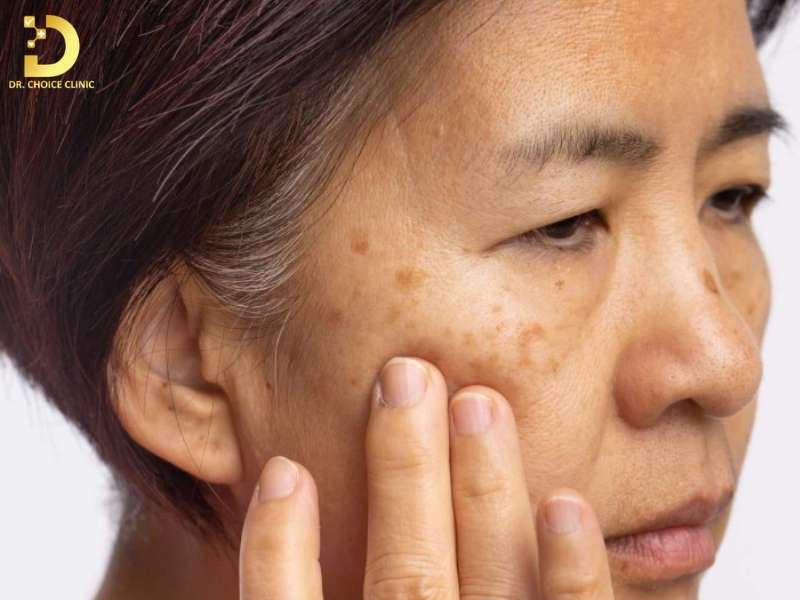 Tàn nhang bẩm sinh là gì? góc nhìn da liễu về rối loạn sắc tố di truyền