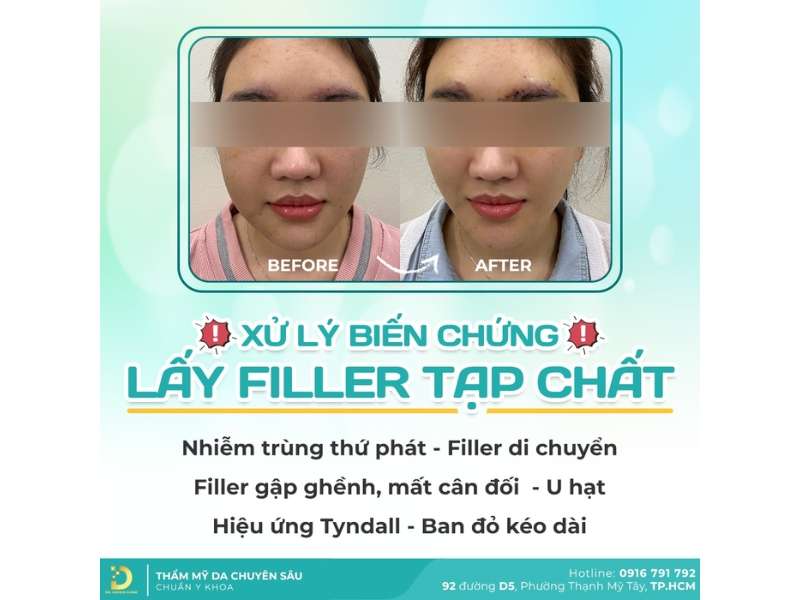 Xử lý biến chứng lấy filler tạp chất