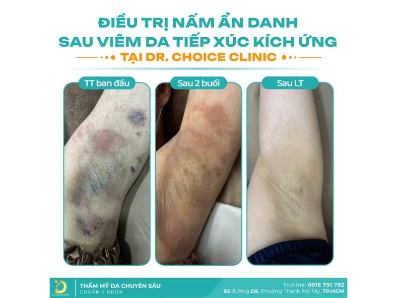 Chi phí điều trị nấm thân mình tại Dr. Choice Clinic như thế nào?