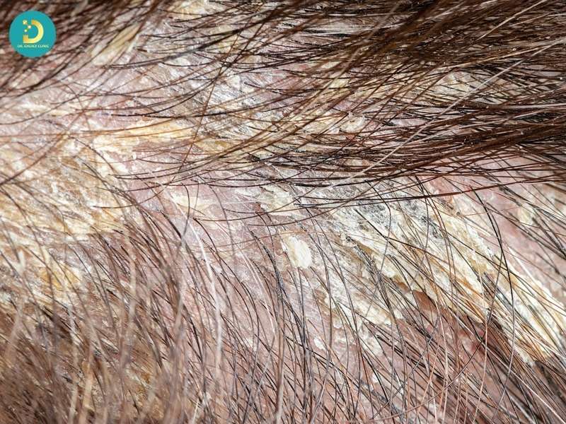 Cơ chế gây bệnh của vi nấm