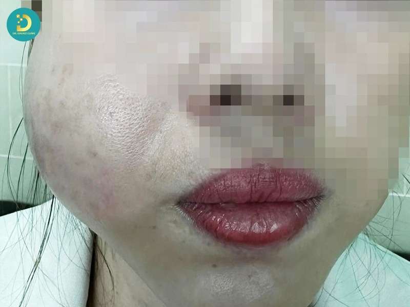 Dấu hiệu nhận biết filler sai cách là gì? khi nào cần xử lý ngay?