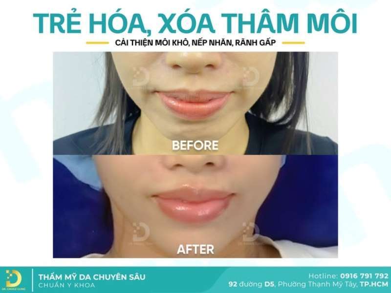 Feedback từ khách hàng đã xóa nếp nhăn